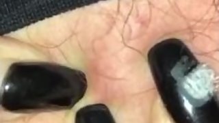 Pimple Popping Pimple on Lip German couple press out pimples instagram